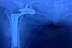 Best Revision Hip Replacement Surgeon in Delhi , NCR - Joint & Bone Solutions