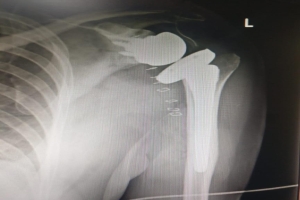 Total Shoulder Replacement Surgery in Delhi, NCR - Joint & Bone Solutions