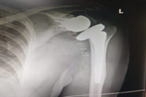 Shoulder-Replacement-Arthroplasty-After