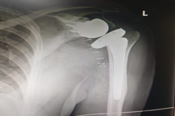 Shoulder-Replacement-Arthroplasty-After