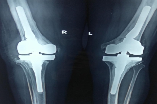 revision knee replacement