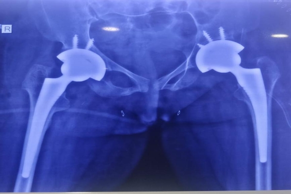 After Image of Total Hip Replacement Surgery - Joint & Bone Solutions
