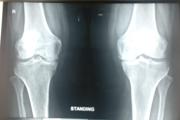 Before Image Of Total Knee Replacement Surgery - Joint & Bone Solutions