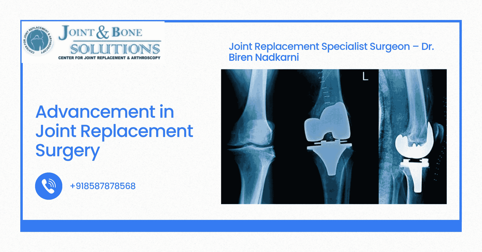 Read more about the article Advancement in Joint Replacement Surgery