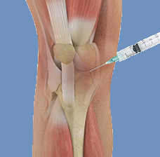 Intra Articular Knee Injections in Delhi, NCR - Joint & Bone Solutions