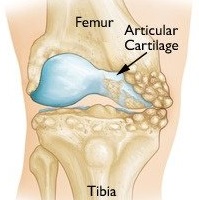 Best Knee Osteotomy Surgery in Delhi, NCR - Joint & Bone Solution