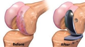 Best Unicompartmental Knee Replacement in Delhi, NCR - Joint & Bone Solutions