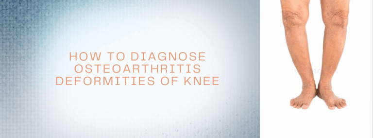 Read more about the article <strong>How to Diagnose Osteoarthritis Deformities of Knee</strong>