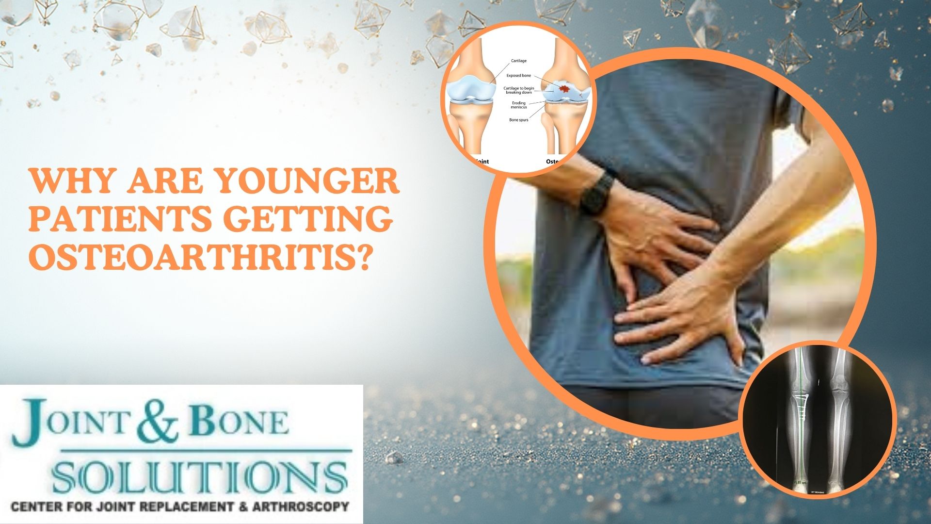 Read more about the article Why Are Younger Patients Getting Osteoarthritis?