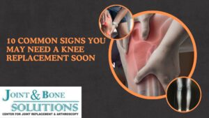 10 Common Signs You May Need a Knee Replacement Soon