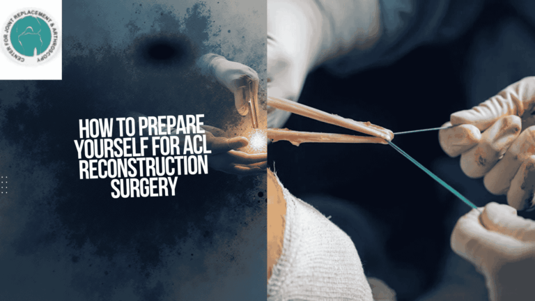 Read more about the article How to Prepare Yourself for ACL Reconstruction Surgery