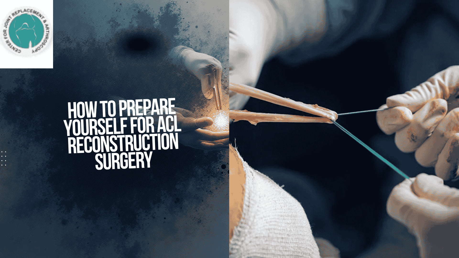 Read more about the article How to Prepare Yourself for ACL Reconstruction Surgery